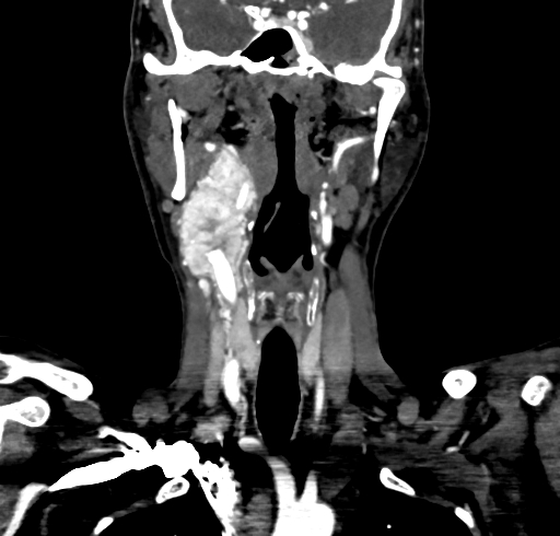 File:Carotid body tumor (Radiopaedia 83615-98727 B 59).jpg