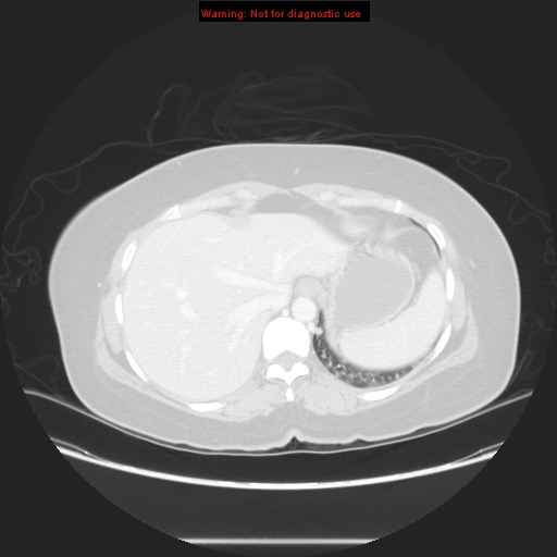 Carotid body tumor with lung metastases (Radiopaedia 9301-48390 Axial lung window 59).jpg
