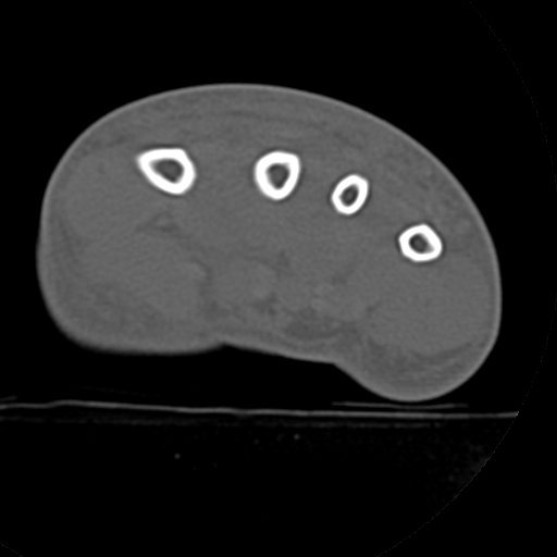 File:Carpo-metacarpal fracture-dislocations with hamatum split fracture (Radiopaedia 18482-18343 Axial bone window 4).jpg