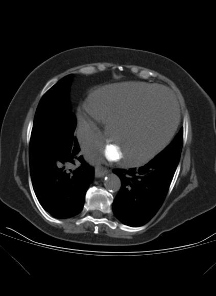 File:Caseous mitral annular calcification (Radiopaedia 61219-69122 Axial non-contrast 13).jpg