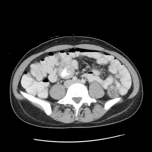 Castleman disease with fibrous pseudotumor in the abdomen (Radiopaedia 77296-89373 A 76).jpg