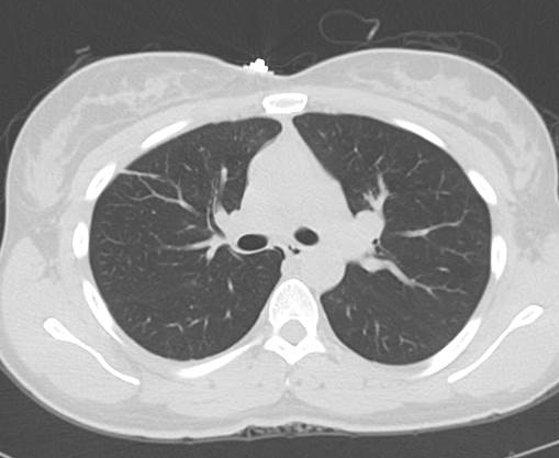 File:Catamenial pneumothorax (Radiopaedia 54382-60600 Axial 11).png