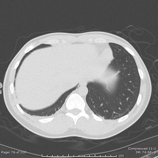 File:Catamenial pneumothorax (Radiopaedia 54382-60600 Axial non-contrast 76).jpg