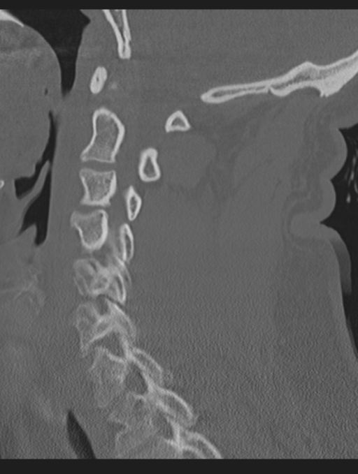Cavernoma of cervical cord (Radiopaedia 50838-56346 Sagittal bone window 35).png