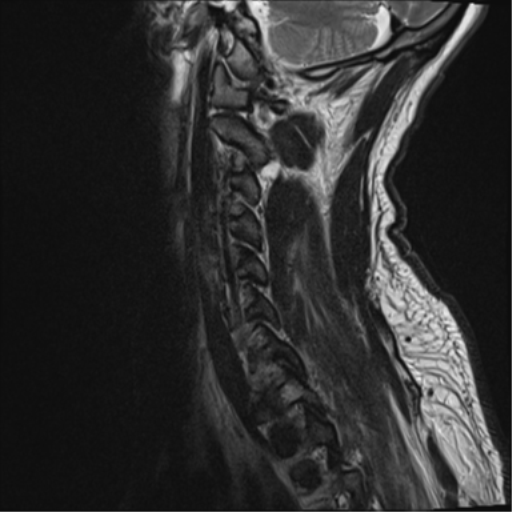 File:Cavernoma of cervical cord (Radiopaedia 50838-56347 C 3).png