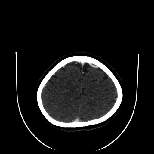Cavernoma with developmental venous anomaly (Radiopaedia 22470-22506 C 163).jpg