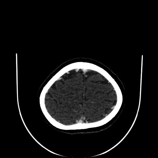 Cavernoma with developmental venous anomaly (Radiopaedia 22470-22506 C 172).jpg