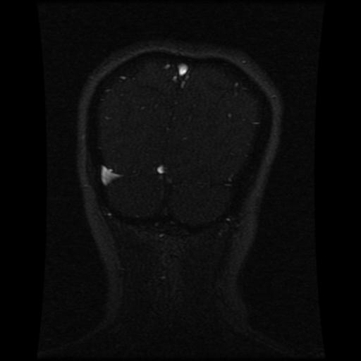Cavernoma with developmental venous anomaly (Radiopaedia 22470-22507 MRV 35).jpg