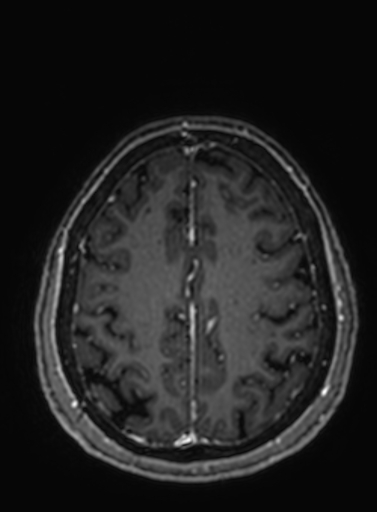 Cavernous hemangioma of the cerebellar falx (Radiopaedia 73025-83724 Axial T1 C+ 91).jpg