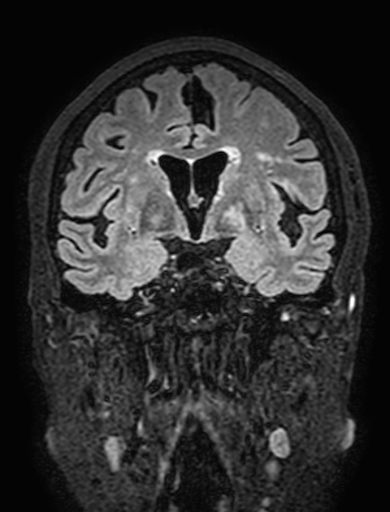 Cavernous hemangioma of the cerebellar falx (Radiopaedia 73025-83724 Coronal FLAIR 153).jpg
