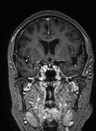 Cavernous hemangioma of the cerebellar falx (Radiopaedia 73025-83724 Coronal T1 C+ 156).jpg