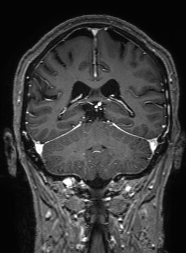 Cavernous hemangioma of the cerebellar falx (Radiopaedia 73025-83724 Coronal T1 C+ 250).jpg