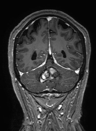 Cavernous hemangioma of the cerebellar falx (Radiopaedia 73025-83724 Coronal T1 C+ 284).jpg