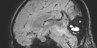 Cavernous hemangioma of the cerebellar falx (Radiopaedia 73025-83724 Sagittal BOLD 106).jpg