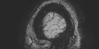 Cavernous hemangioma of the cerebellar falx (Radiopaedia 73025-83724 Sagittal BOLD 195).jpg