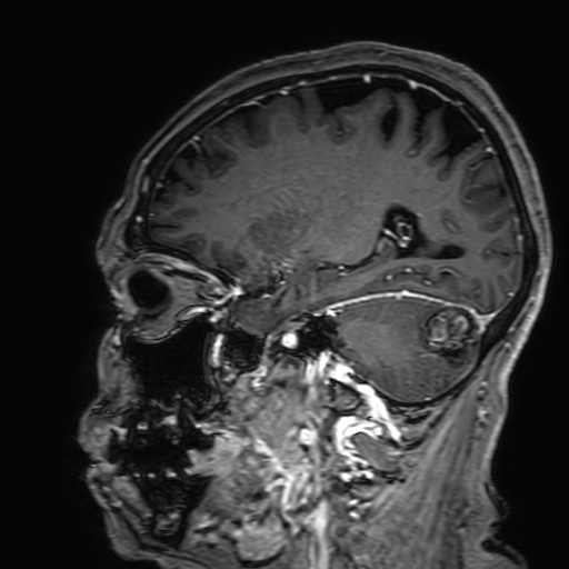 Cavernous hemangioma of the cerebellar falx (Radiopaedia 73025-83724 Sagittal T1 C+ 141).jpg