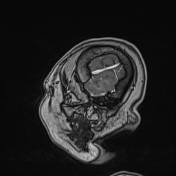 Cavernous sinus meningioma (Radiopaedia 63682-72367 Sagittal T1 C+ 151).jpg