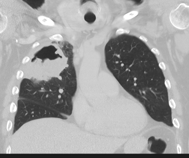 Cavitating pneumonia (Radiopaedia 45998-50329 Coronal lung window 19).png
