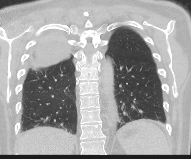 Cavitating pneumonia (Radiopaedia 45998-50329 Coronal lung window 37).png