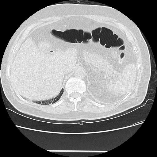 Cavitating pulmonary metastases (Radiopaedia 89545-106544 Axial lung window 55).jpg