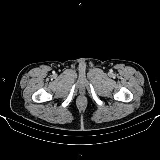Cecal adenocarcinoma (Radiopaedia 85324-100916 B 110).jpg