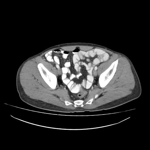File:Cecal carcinoma with local lymphadenopathy (Radiopaedia 31428-32240 A 45).jpg