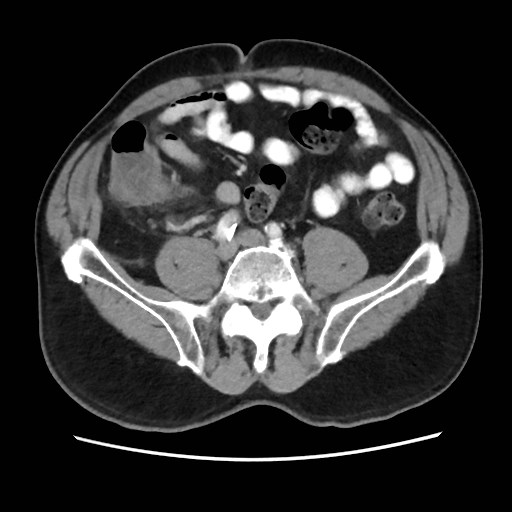 Cecal mass causing appendicitis (Radiopaedia 59207-66531 A 58).jpg