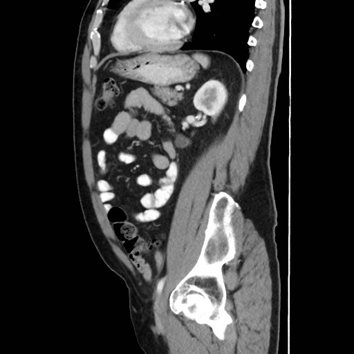 Cecal mass causing appendicitis (Radiopaedia 59207-66531 C 44).jpg