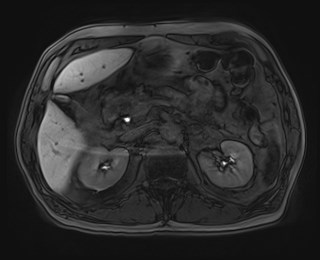 File:Cecal mass causing appendicitis (Radiopaedia 59207-66532 K 49).jpg