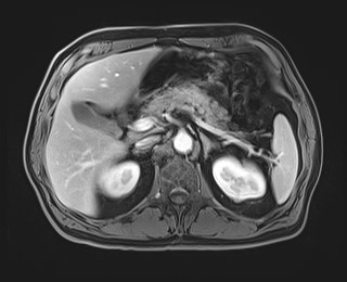 Cecal mass causing appendicitis (Radiopaedia 59207-66532 T1 C+ PV phase 46).jpg
