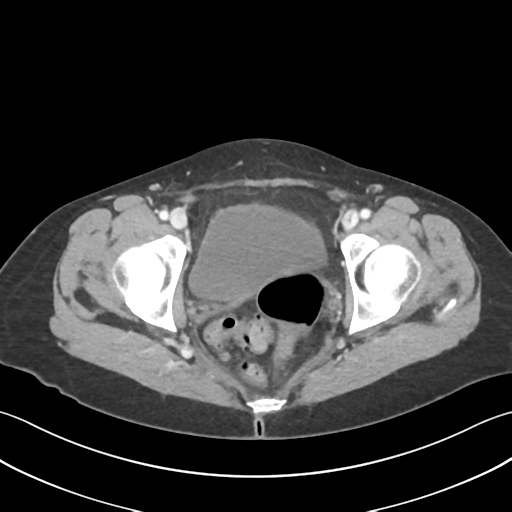 Cecum hernia through the foramen of Winslow (Radiopaedia 46634-51112 A 68).png
