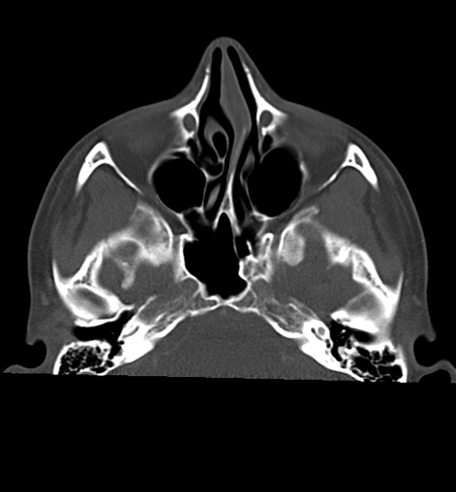 File:Cemento-ossifying fibroma (Radiopaedia 46243-50643 Axial bone window 22).png