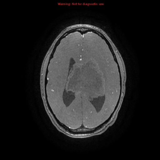 Central neurocytoma (Radiopaedia 13188-13206 Axial MRA 10).jpg