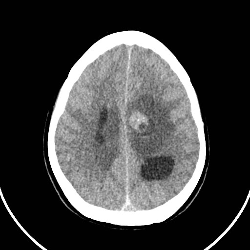Central neurocytoma (Radiopaedia 84497-99871 Axial non-contrast 37).jpg