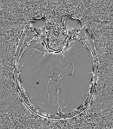 Central neurocytoma (Radiopaedia 84497-99872 Axial 29).jpg