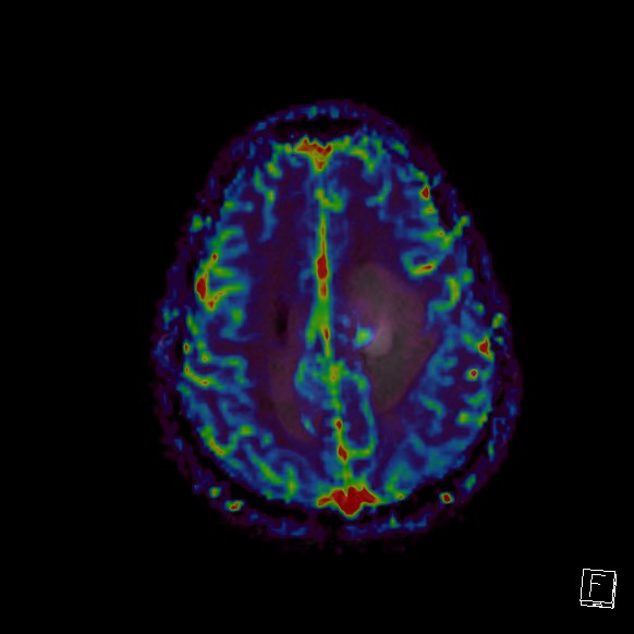 Central neurocytoma (Radiopaedia 84497-99872 Axial Perfusion 77).jpg