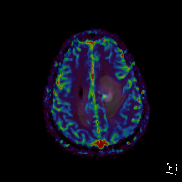 Central neurocytoma (Radiopaedia 84497-99872 Axial Perfusion 87).jpg
