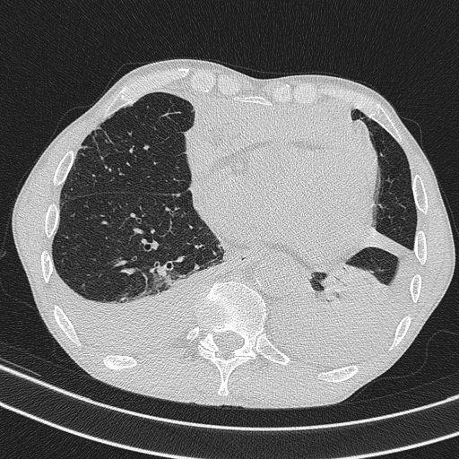 Central venous catheter tip extravasation (Radiopaedia 82828-97113 Axial lung window 61).jpg
