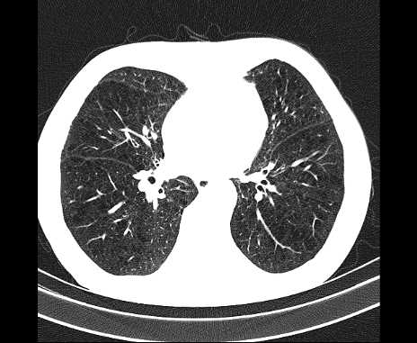 Centrilobular pulmonary emphysema (Radiopaedia 62468-70718 Axial lung window 47).jpg