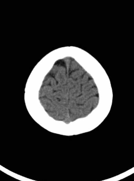 Cerebellar abscess (Radiopaedia 73727-84527 Axial non-contrast 59).jpg