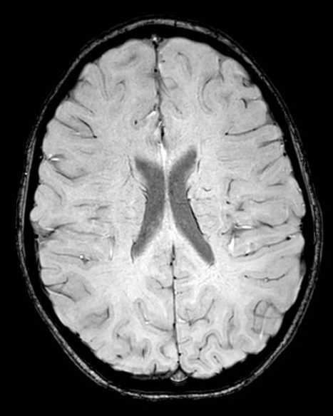 Cerebellar abscess (Radiopaedia 73727-84563 Axial SWI 46).jpg