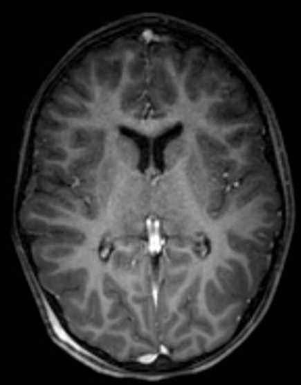 Cerebellar abscess (Radiopaedia 73727-84563 Axial T1 C+ fat sat 66).jpg