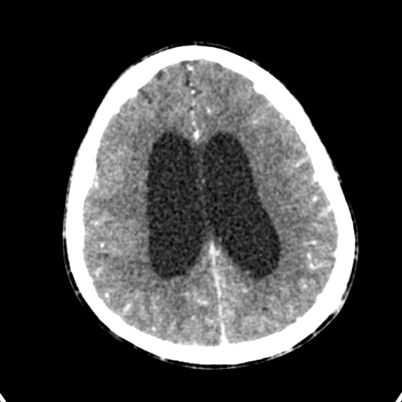 Cerebellar abscess secondary to mastoiditis (Radiopaedia 26284-26412 Axial C+ delayed 108).jpg