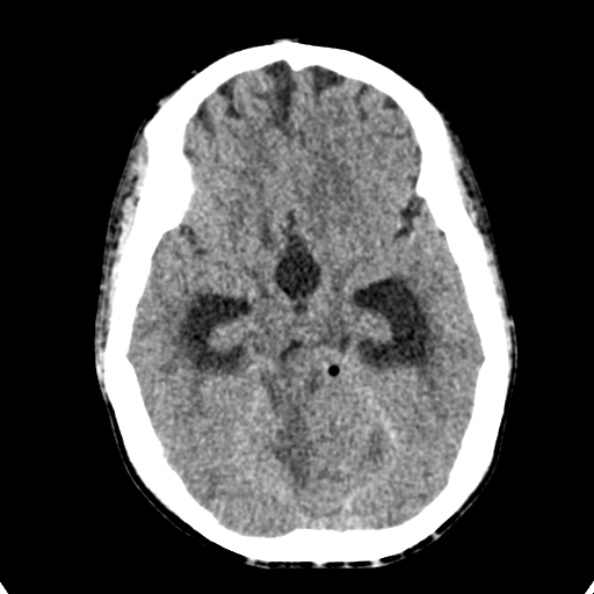 File:Cerebellar abscess secondary to mastoiditis (Radiopaedia 26284-26412 Axial non-contrast 60).jpg