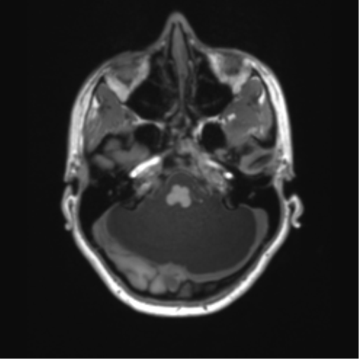 File:Cerebellar agenesis with hypoplastic pons (pontocerebellar hypoplasia) (Radiopaedia 57224-64138 Axial T1 20).png