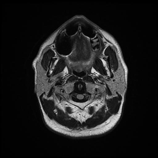 File:Cerebellar hemangioblastoma (Radiopaedia 88055-104622 Axial FLAIR 3).jpg