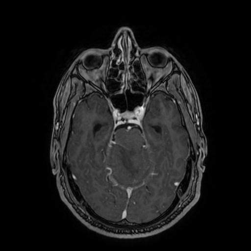 Cerebellar hemangioblastoma (Radiopaedia 88055-104622 Axial T1 C+ 71).jpg