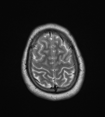 File:Cerebellar hemangioblastomas and pituitary adenoma (Radiopaedia 85490-101176 Axial T2 31).png