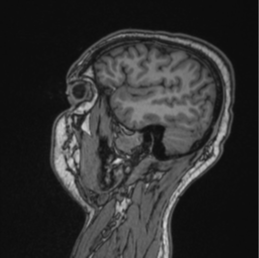 Cerebellar hemangioblastomas and pituitary adenoma (Radiopaedia 85490-101176 Sagittal T1 32).png