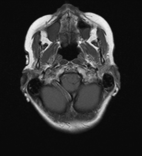 File:Cerebellar metastases (Radiopaedia 24038-24249 Axial T1 16).jpg